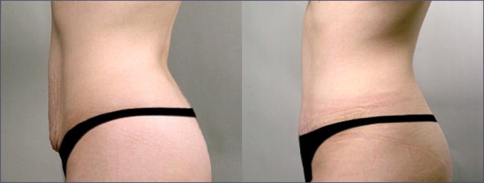 Tummy Tuck Case 701 Before & After View #2 | Paramus, New Jersey | Parker Center for Plastic Surgery