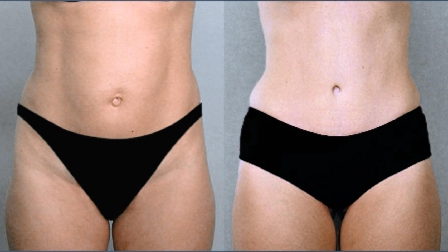Tummy Tuck Case 702 Before & After View #1 | Paramus, New Jersey | Parker Center for Plastic Surgery