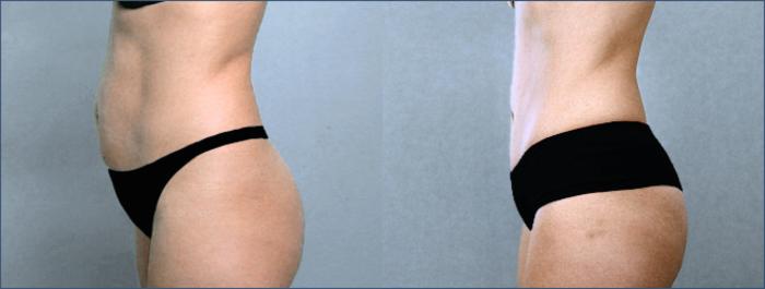 Tummy Tuck Case 702 Before & After View #2 | Paramus, New Jersey | Parker Center for Plastic Surgery