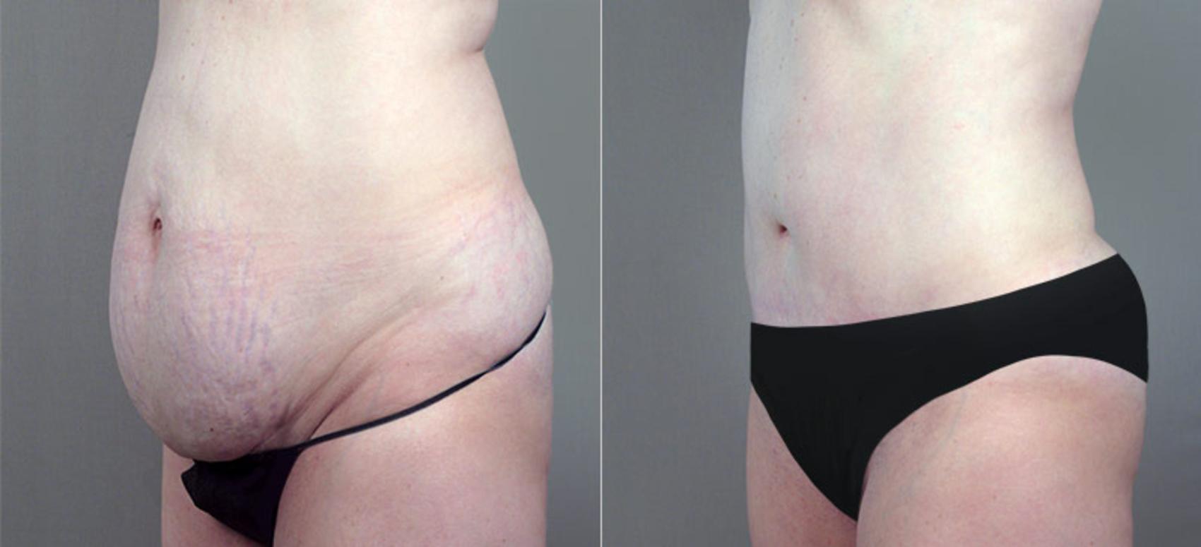 Tummy Tuck Case 703 Before & After View #2 | Paramus, New Jersey | Parker Center for Plastic Surgery