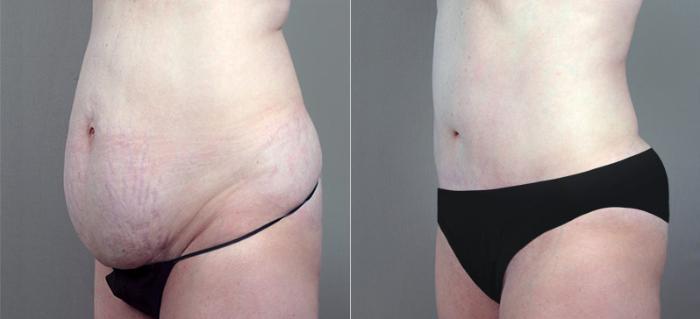 Tummy Tuck Case 703 Before & After View #2 | Paramus, New Jersey | Parker Center for Plastic Surgery