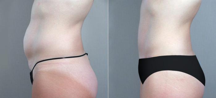 Tummy Tuck Case 704 Before & After View #1 | Paramus, New Jersey | Parker Center for Plastic Surgery