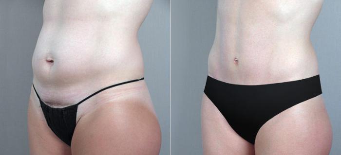 Tummy Tuck Case 704 Before & After View #2 | Paramus, New Jersey | Parker Center for Plastic Surgery