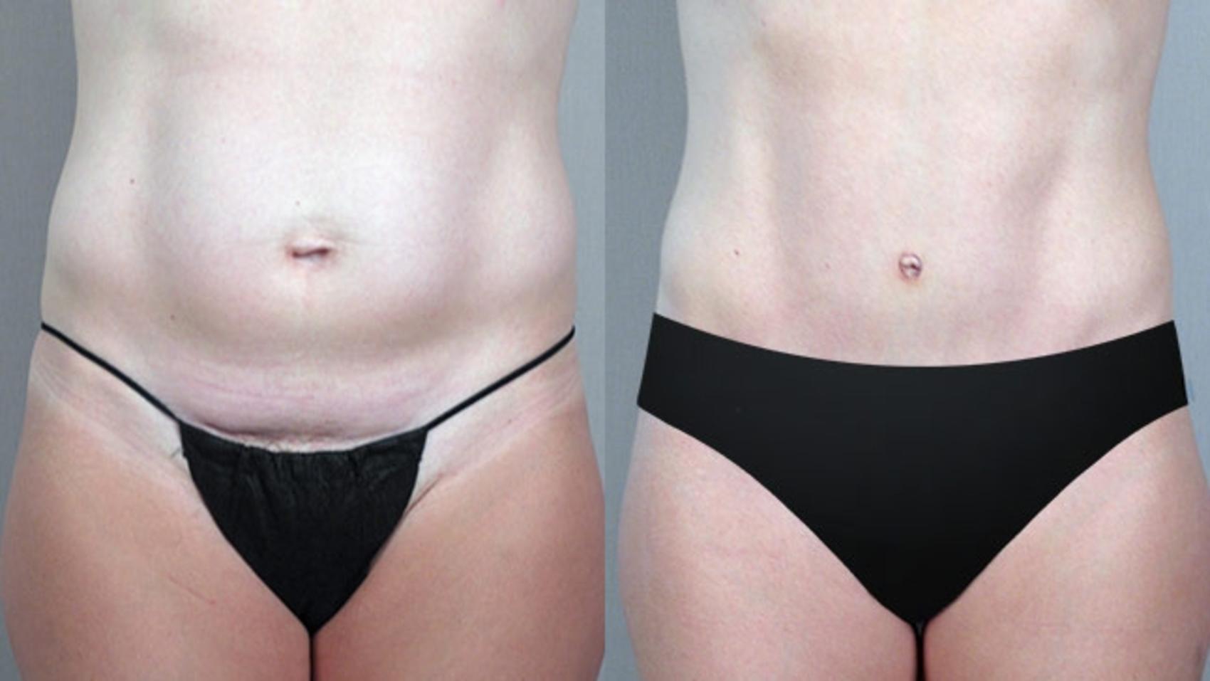Tummy Tuck Case 704 Before & After View #3 | Paramus, New Jersey | Parker Center for Plastic Surgery