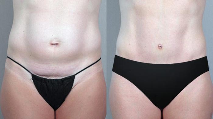 Tummy Tuck Case 704 Before & After View #3 | Paramus, New Jersey | Parker Center for Plastic Surgery