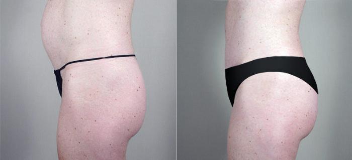Tummy Tuck Case 705 Before & After View #1 | Paramus, New Jersey | Parker Center for Plastic Surgery