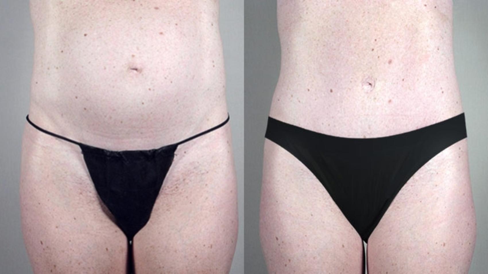 Tummy Tuck Case 705 Before & After View #2 | Paramus, New Jersey | Parker Center for Plastic Surgery