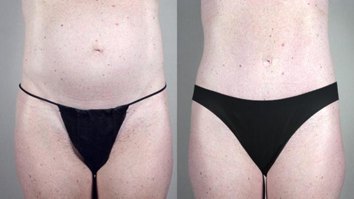 Tummy Tuck Case 705 Before & After View #2 | Paramus, New Jersey | Parker Center for Plastic Surgery