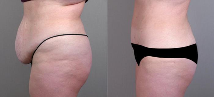 Tummy Tuck Case 706 Before & After View #2 | Paramus, New Jersey | Parker Center for Plastic Surgery