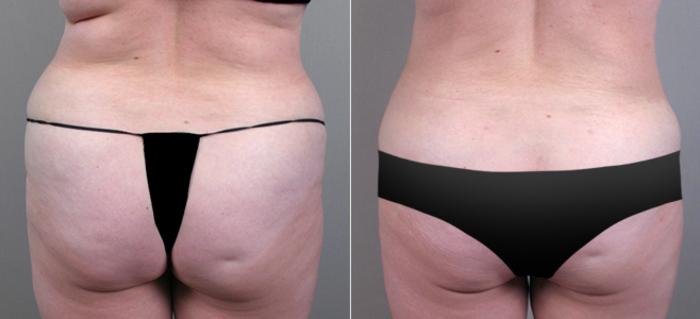 Tummy Tuck Case 706 Before & After View #3 | Paramus, New Jersey | Parker Center for Plastic Surgery
