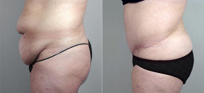 Liposuction Case 707 Before & After View #2 | Paramus, New Jersey | Parker Center for Plastic Surgery