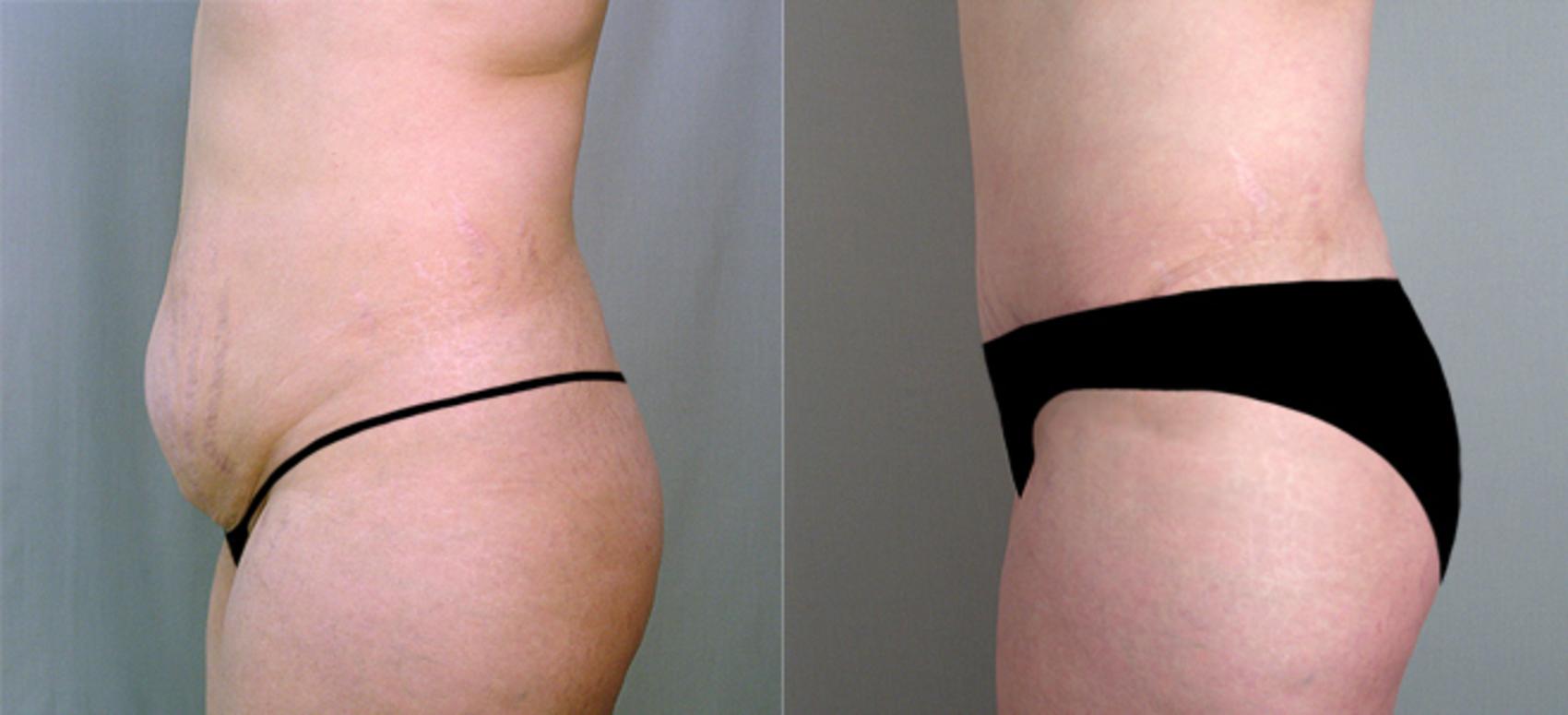 Tummy Tuck Case 708 Before & After View #2 | Paramus, New Jersey | Parker Center for Plastic Surgery