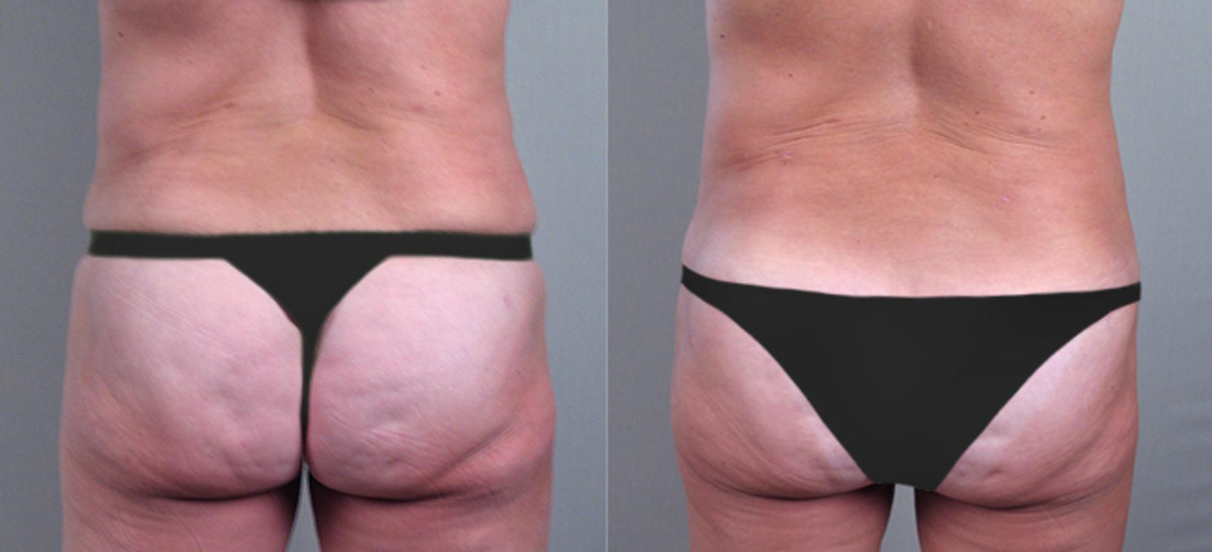 Tummy Tuck Case 709 Before & After View #2 | Paramus, New Jersey | Parker Center for Plastic Surgery