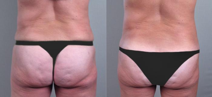 Tummy Tuck Case 709 Before & After View #2 | Paramus, New Jersey | Parker Center for Plastic Surgery