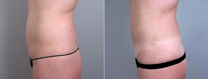 Tummy Tuck Case 710 Before & After View #2 | Paramus, New Jersey | Parker Center for Plastic Surgery