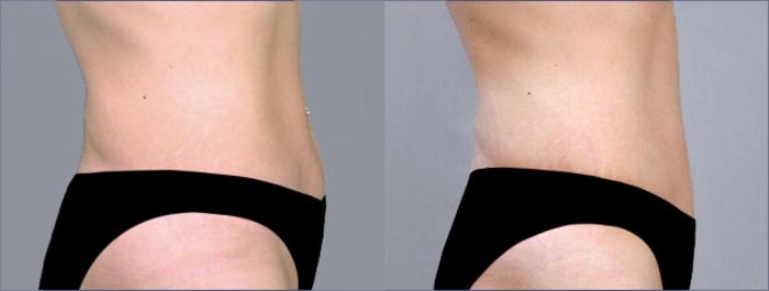 Tummy Tuck Case 711 Before & After View #2 | Paramus, New Jersey | Parker Center for Plastic Surgery