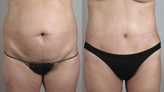 Liposuction Case 715 Before & After View #1 | Paramus, New Jersey | Parker Center for Plastic Surgery