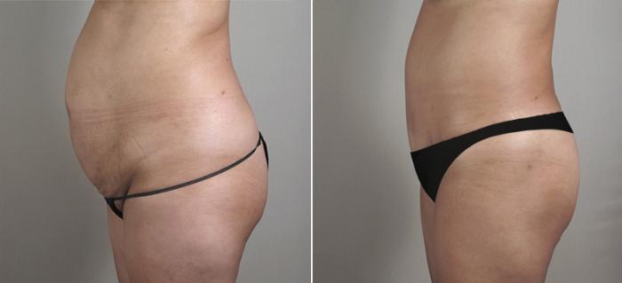 Liposuction Case 715 Before & After View #2 | Paramus, New Jersey | Parker Center for Plastic Surgery