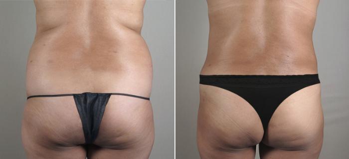 Liposuction Case 715 Before & After View #3 | Paramus, New Jersey | Parker Center for Plastic Surgery