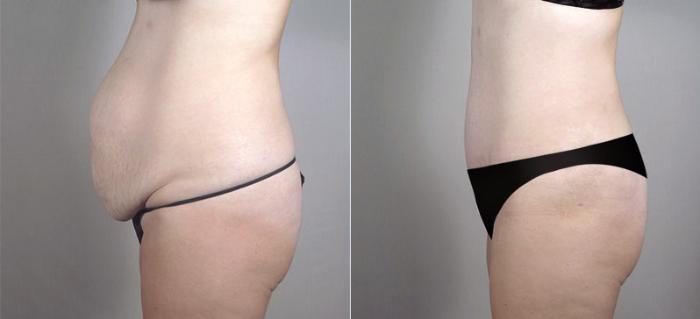 Liposuction Case 718 Before & After View #2 | Paramus, New Jersey | Parker Center for Plastic Surgery
