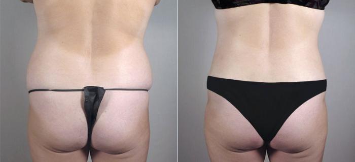 Liposuction Case 718 Before & After View #3 | Paramus, New Jersey | Parker Center for Plastic Surgery