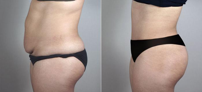 Tummy Tuck Case 719 Before & After View #2 | Paramus, New Jersey | Parker Center for Plastic Surgery