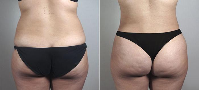 Tummy Tuck Case 719 Before & After View #3 | Paramus, New Jersey | Parker Center for Plastic Surgery