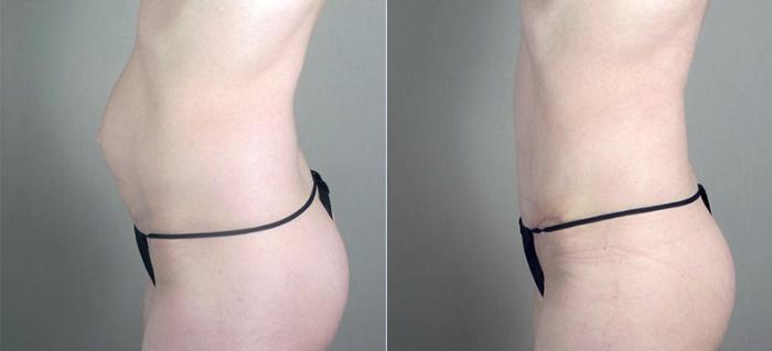 Tummy Tuck Case 720 Before & After View #1 | Paramus, New Jersey | Parker Center for Plastic Surgery