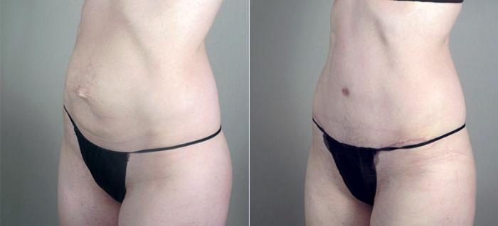 Tummy Tuck Case 720 Before & After View #2 | Paramus, New Jersey | Parker Center for Plastic Surgery