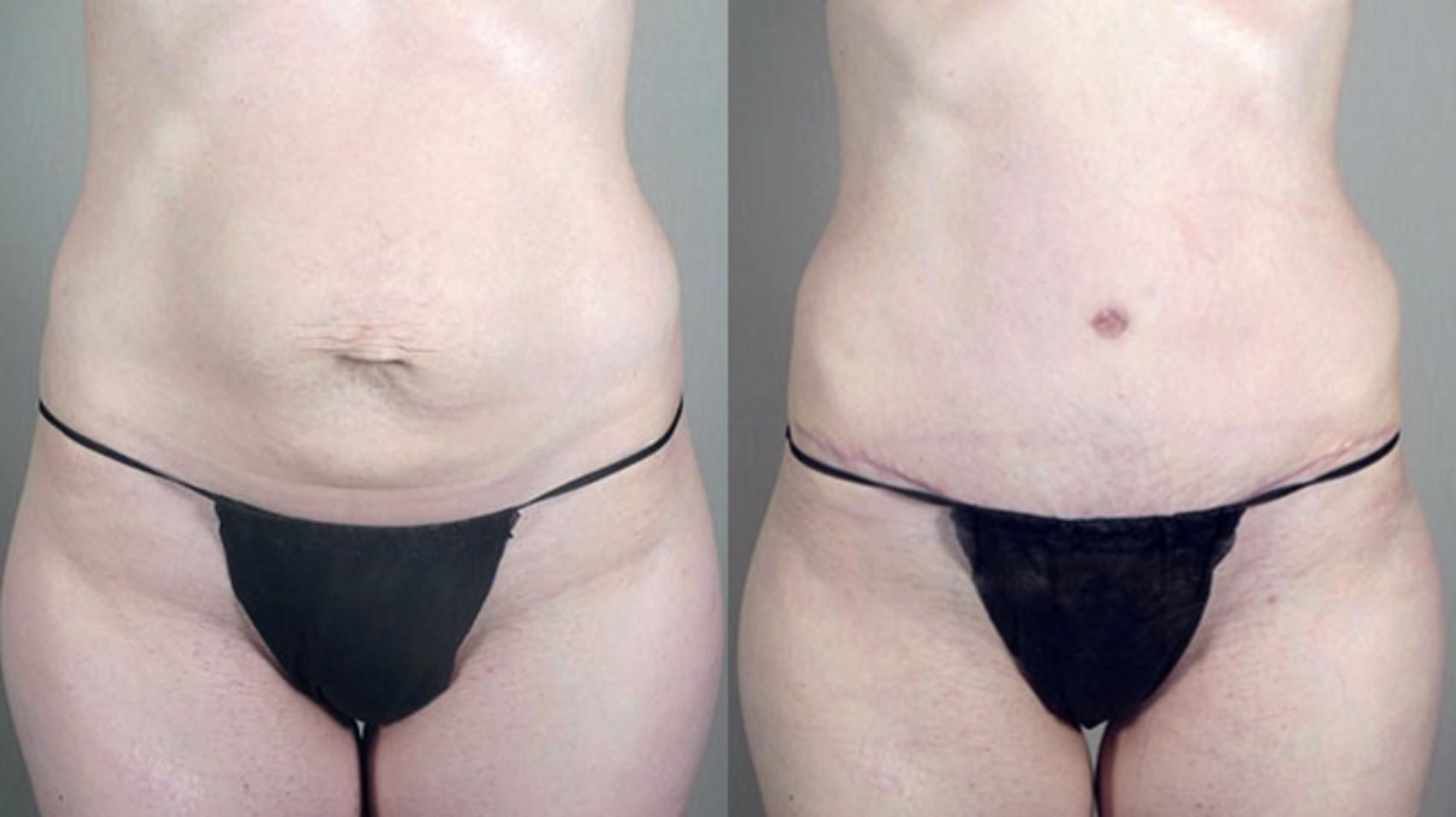 Tummy Tuck Case 720 Before & After View #3 | Paramus, New Jersey | Parker Center for Plastic Surgery