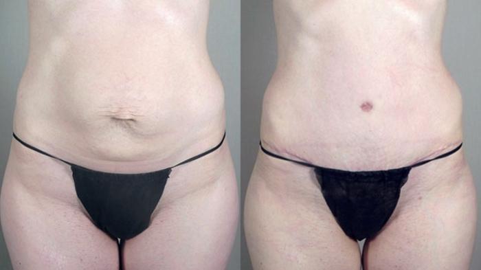 Tummy Tuck Case 720 Before & After View #3 | Paramus, New Jersey | Parker Center for Plastic Surgery