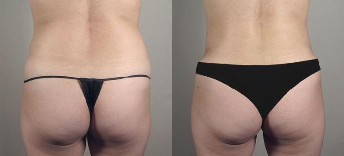 Tummy Tuck Case 721 Before & After View #3 | Paramus, New Jersey | Parker Center for Plastic Surgery