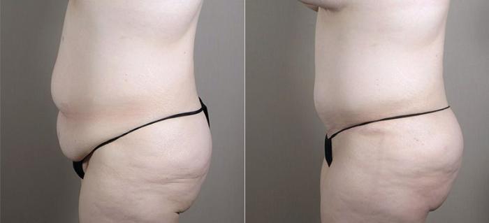 Tummy Tuck Case 726 Before & After View #2 | Paramus, New Jersey | Parker Center for Plastic Surgery