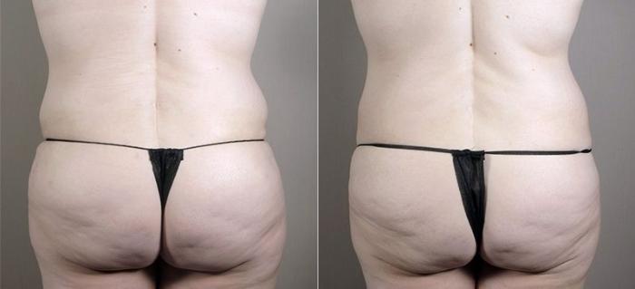 Tummy Tuck Case 726 Before & After View #3 | Paramus, New Jersey | Parker Center for Plastic Surgery