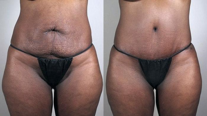 Tummy Tuck Case 727 Before & After View #1 | Paramus, New Jersey | Parker Center for Plastic Surgery