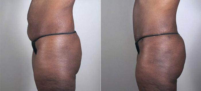 Tummy Tuck Case 727 Before & After View #2 | Paramus, New Jersey | Parker Center for Plastic Surgery