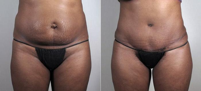 Tummy Tuck Case 728 Before & After View #1 | Paramus, New Jersey | Parker Center for Plastic Surgery