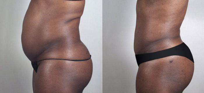 Tummy Tuck Case 729 Before & After View #2 | Paramus, New Jersey | Parker Center for Plastic Surgery