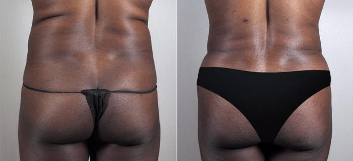 Tummy Tuck Case 729 Before & After View #3 | Paramus, New Jersey | Parker Center for Plastic Surgery
