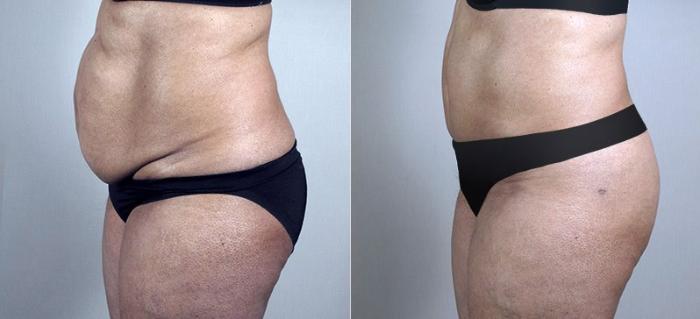Tummy Tuck Case 731 Before & After View #2 | Paramus, New Jersey | Parker Center for Plastic Surgery