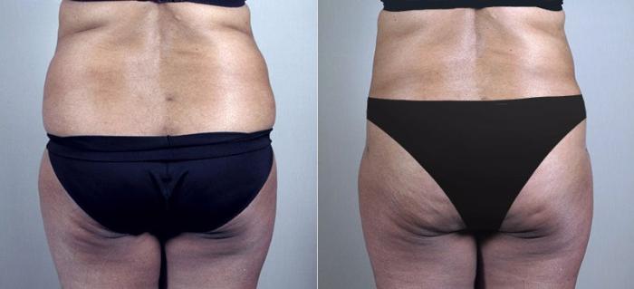 Tummy Tuck Case 731 Before & After View #3 | Paramus, New Jersey | Parker Center for Plastic Surgery