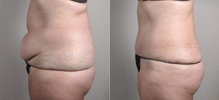Tummy Tuck Case 733 Before & After View #2 | Paramus, New Jersey | Parker Center for Plastic Surgery