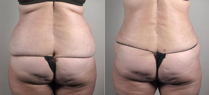 Tummy Tuck Case 733 Before & After View #3 | Paramus, New Jersey | Parker Center for Plastic Surgery