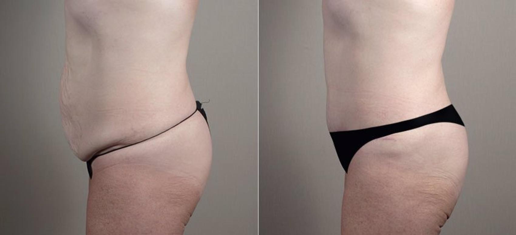 Tummy Tuck Case 734 Before & After View #1 | Paramus, New Jersey | Parker Center for Plastic Surgery