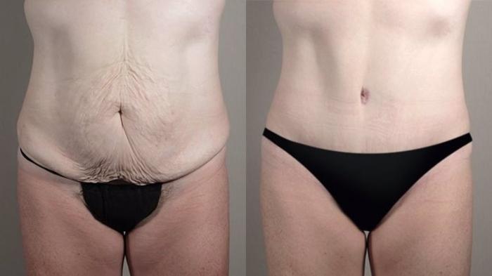 Tummy Tuck Case 734 Before & After View #2 | Paramus, New Jersey | Parker Center for Plastic Surgery