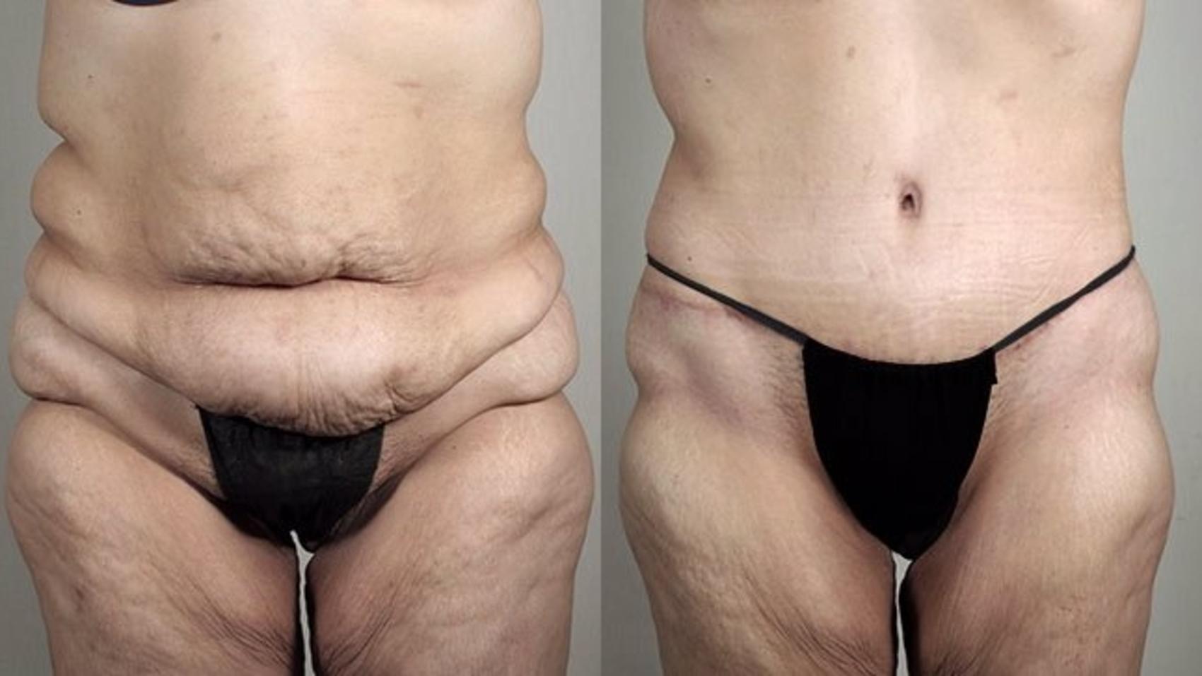 Tummy Tuck Case 739 Before & After View #1 | Paramus, New Jersey | Parker Center for Plastic Surgery