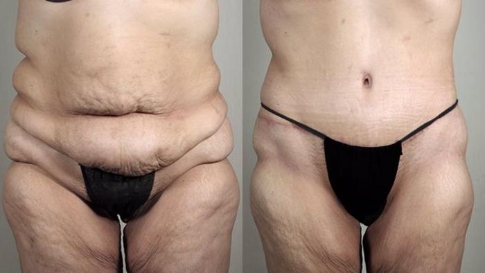 Tummy Tuck Case 739 Before & After View #1 | Paramus, New Jersey | Parker Center for Plastic Surgery