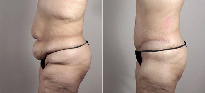 Tummy Tuck Case 739 Before & After View #2 | Paramus, New Jersey | Parker Center for Plastic Surgery