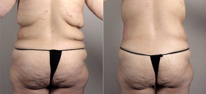 Tummy Tuck Case 739 Before & After View #3 | Paramus, New Jersey | Parker Center for Plastic Surgery