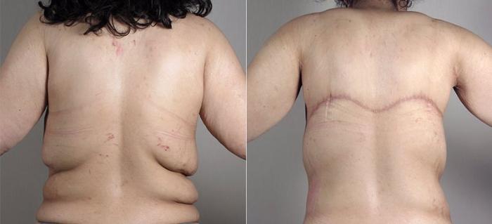 Tummy Tuck Case 739 Before & After View #4 | Paramus, New Jersey | Parker Center for Plastic Surgery